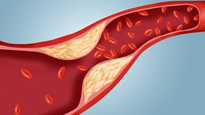 How to Clean Blood Vessels from Cholesterol Residue for 40 days - Alkaline World