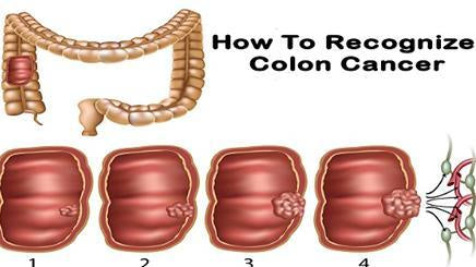 How To Recognize Colon Cancer - Alkaline World