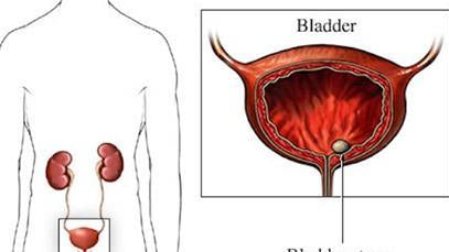 This Natural Antibiotic Treats Every Bladder Infection - Alkaline World